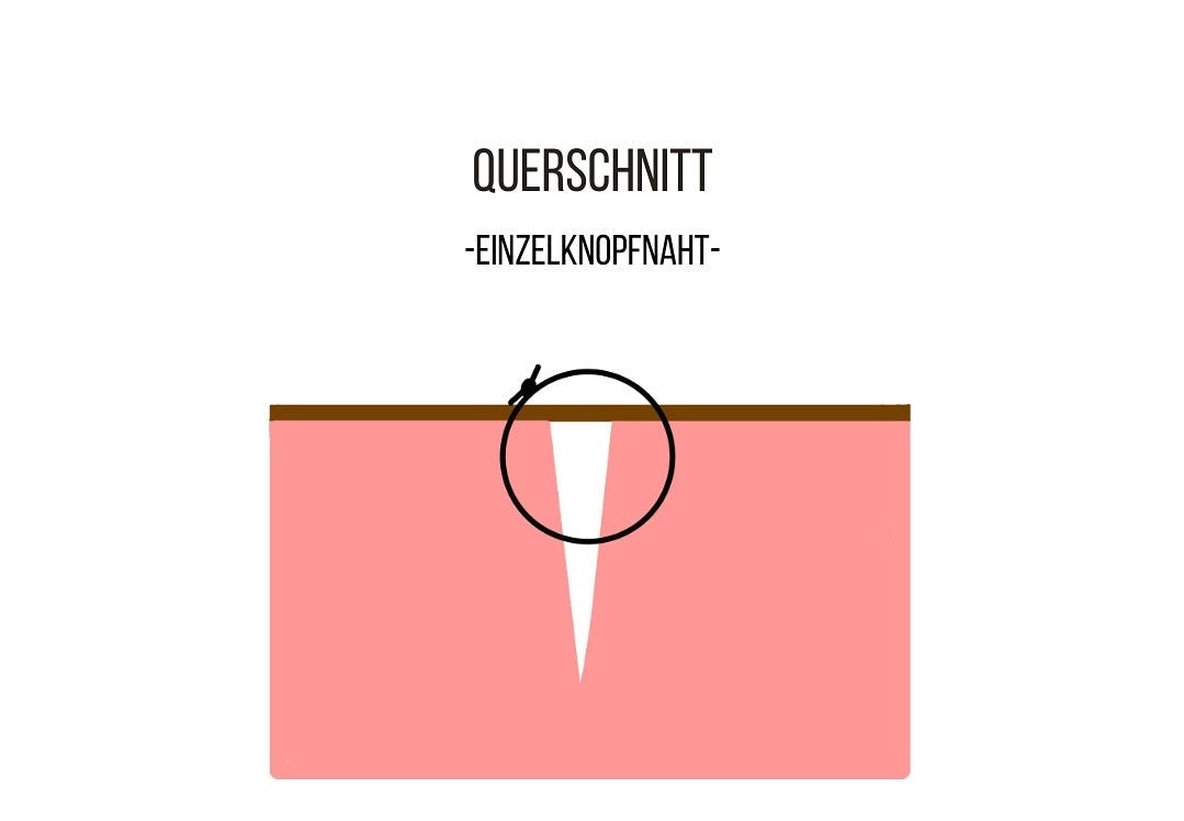 chirurgische Einzelknopfnaht