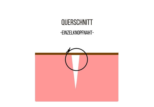 chirurgische Einzelknopfnaht