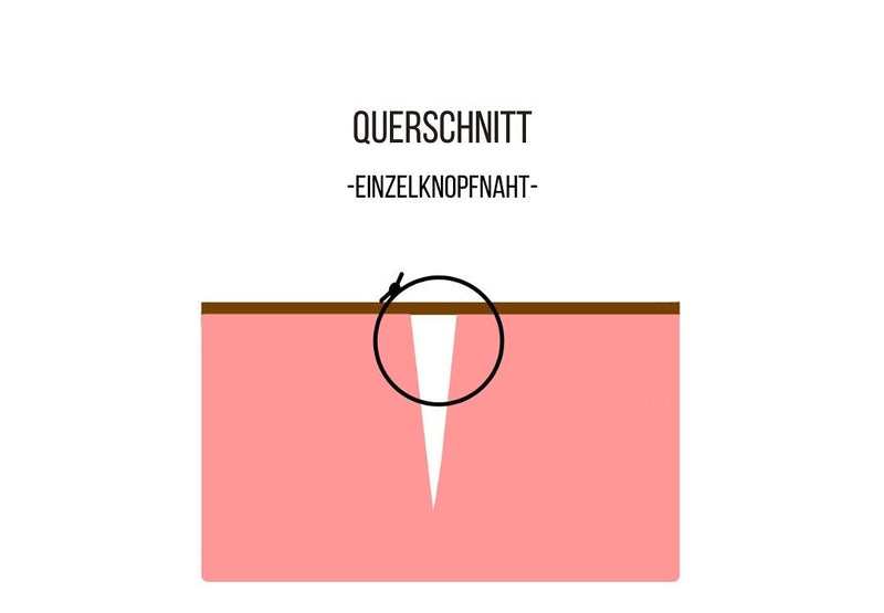 chirurgische Einzelknopfnaht